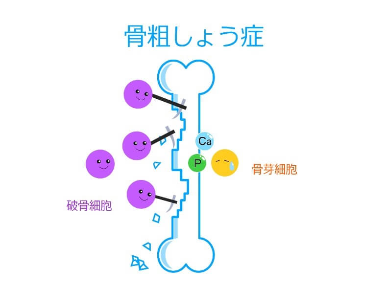 骨粗しょう症とは