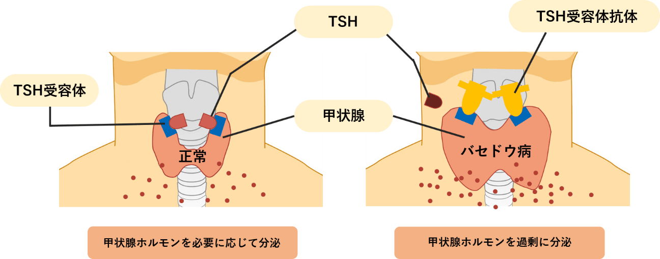 バセドウ病