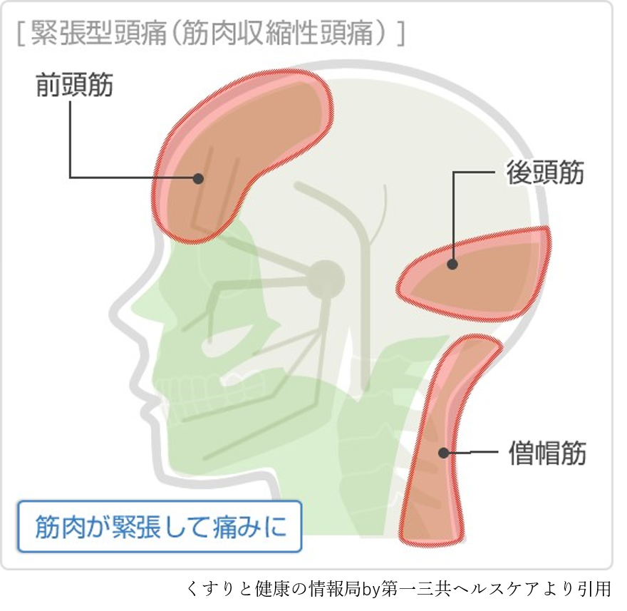 緊張型頭痛