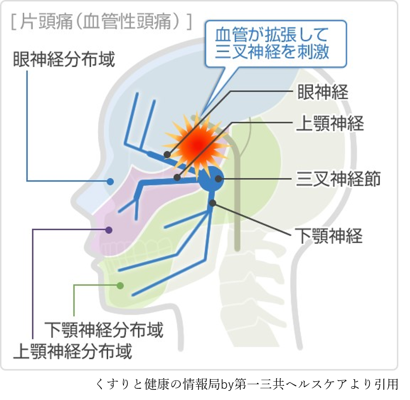 片頭痛