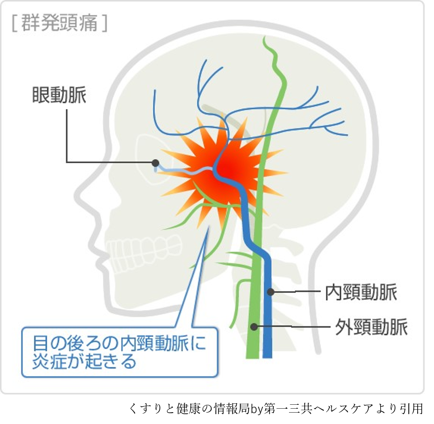 群発頭痛、三叉神経・自律神経性頭痛